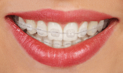 ceramic braces