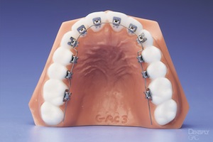 Aviara Centers  Lingual Braces: Your Guide to the Invisible