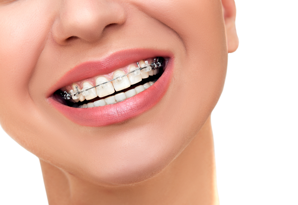 Bethany Orthodontics - Braces