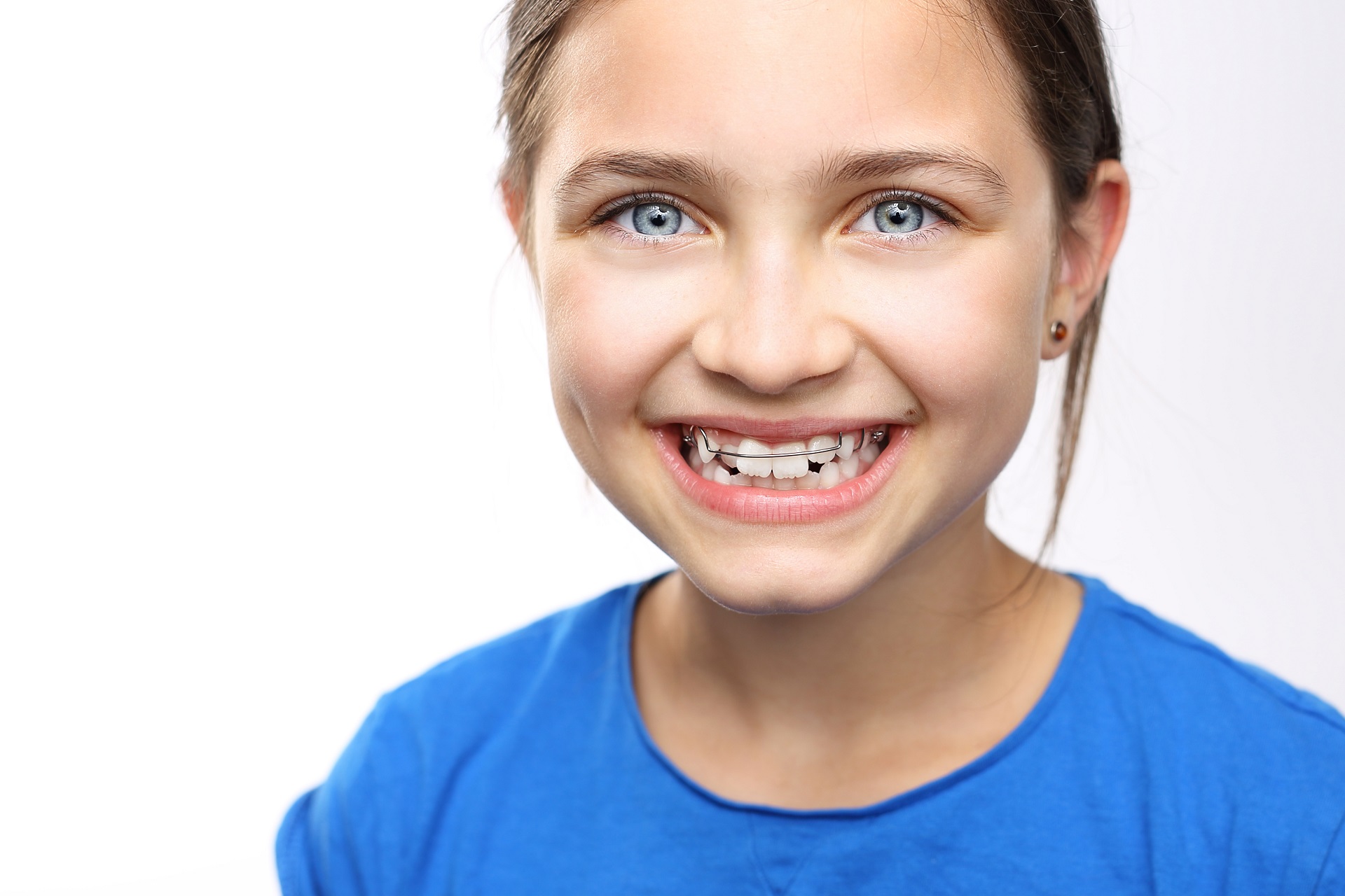 Do All Your Baby Teeth Need To Fall Out Before You Get Braces