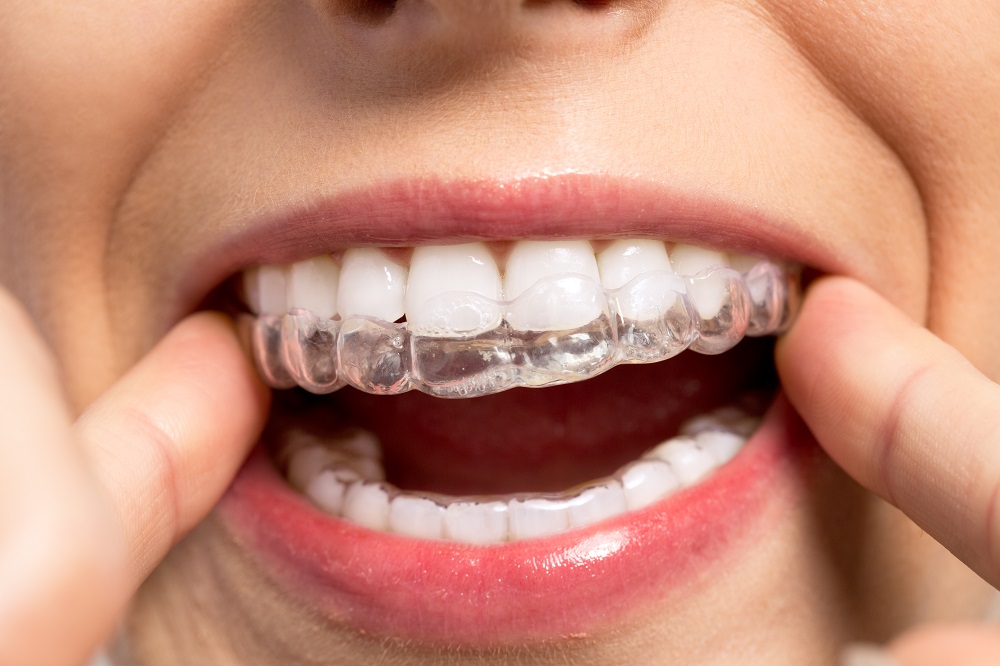 Cleaning Your Braces and Teeth Properly  Kossowan OrthodonticsKossowan  Orthodontics